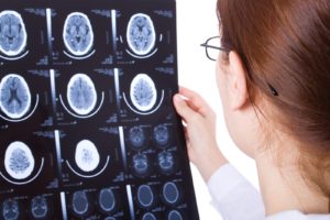 What Is a Catastrophic Brain Injury?
